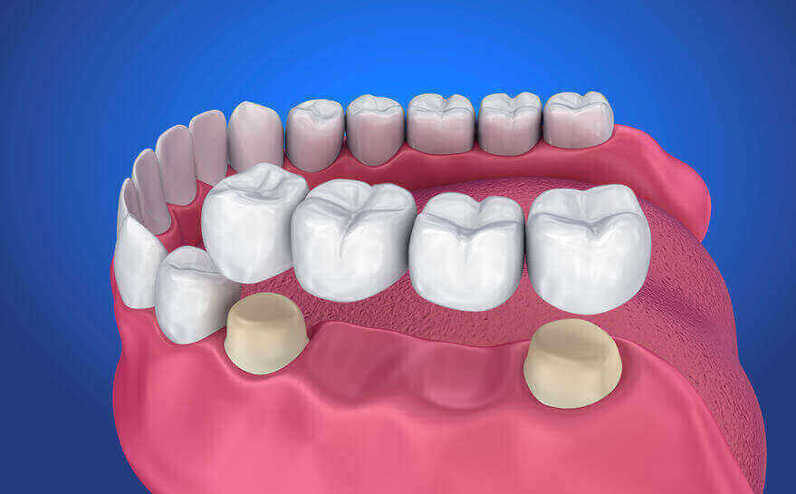 A model of dental crowns.