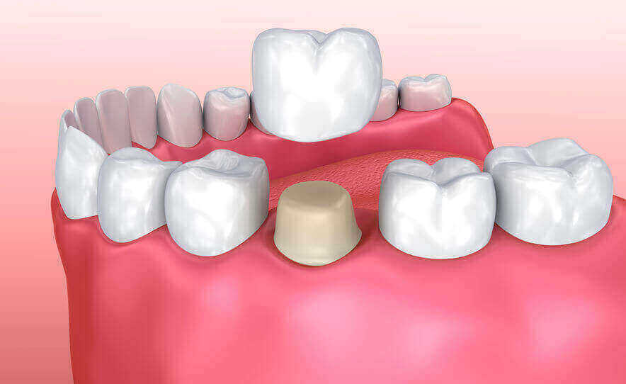 A dental crown.