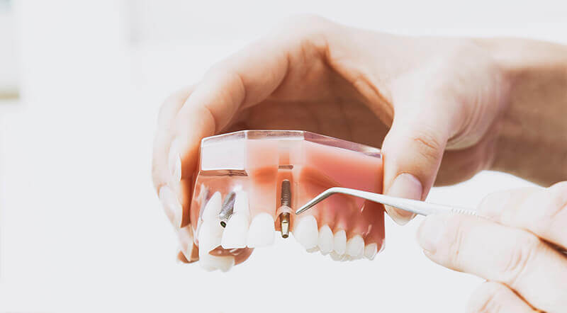 A model of dental implants.