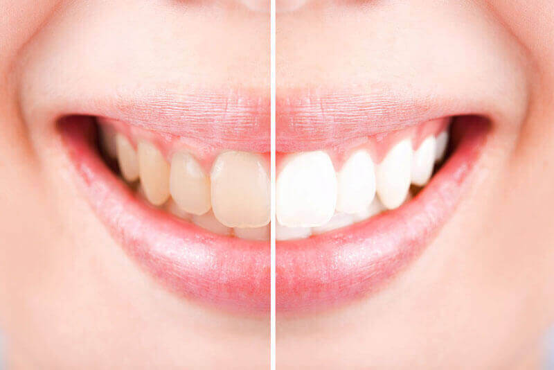 A before and after of whitening teeth.