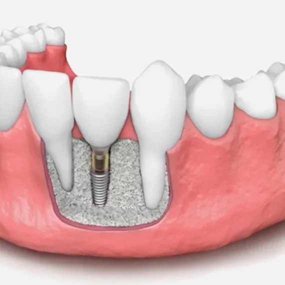 bone-graft.webp